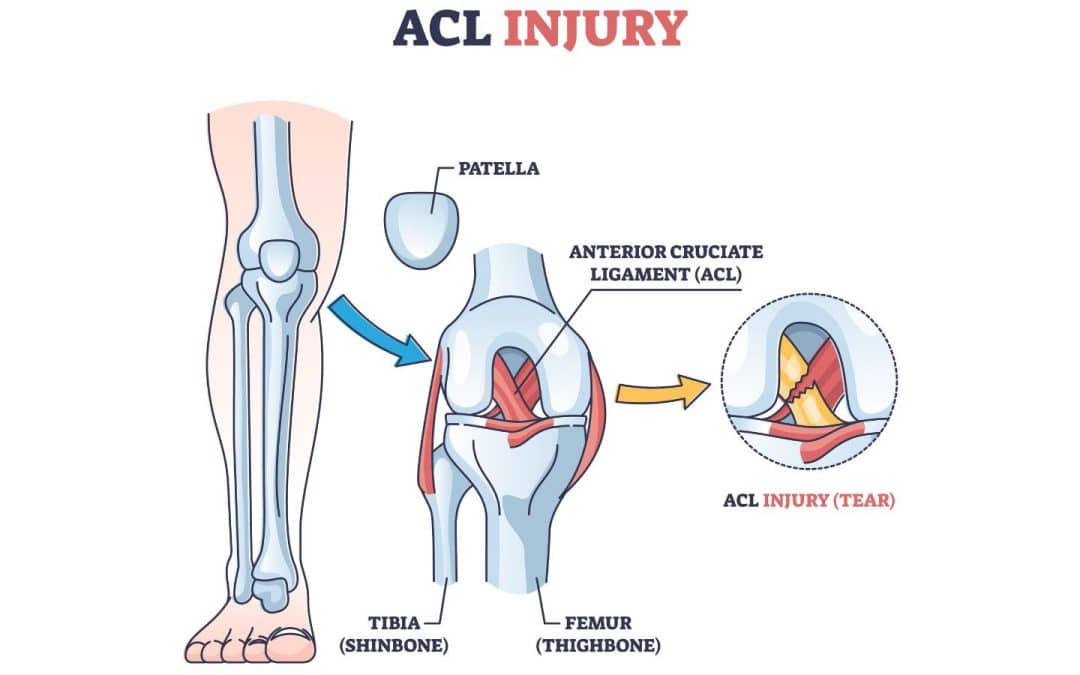 Understanding ACL Tears and Their Treatment Options