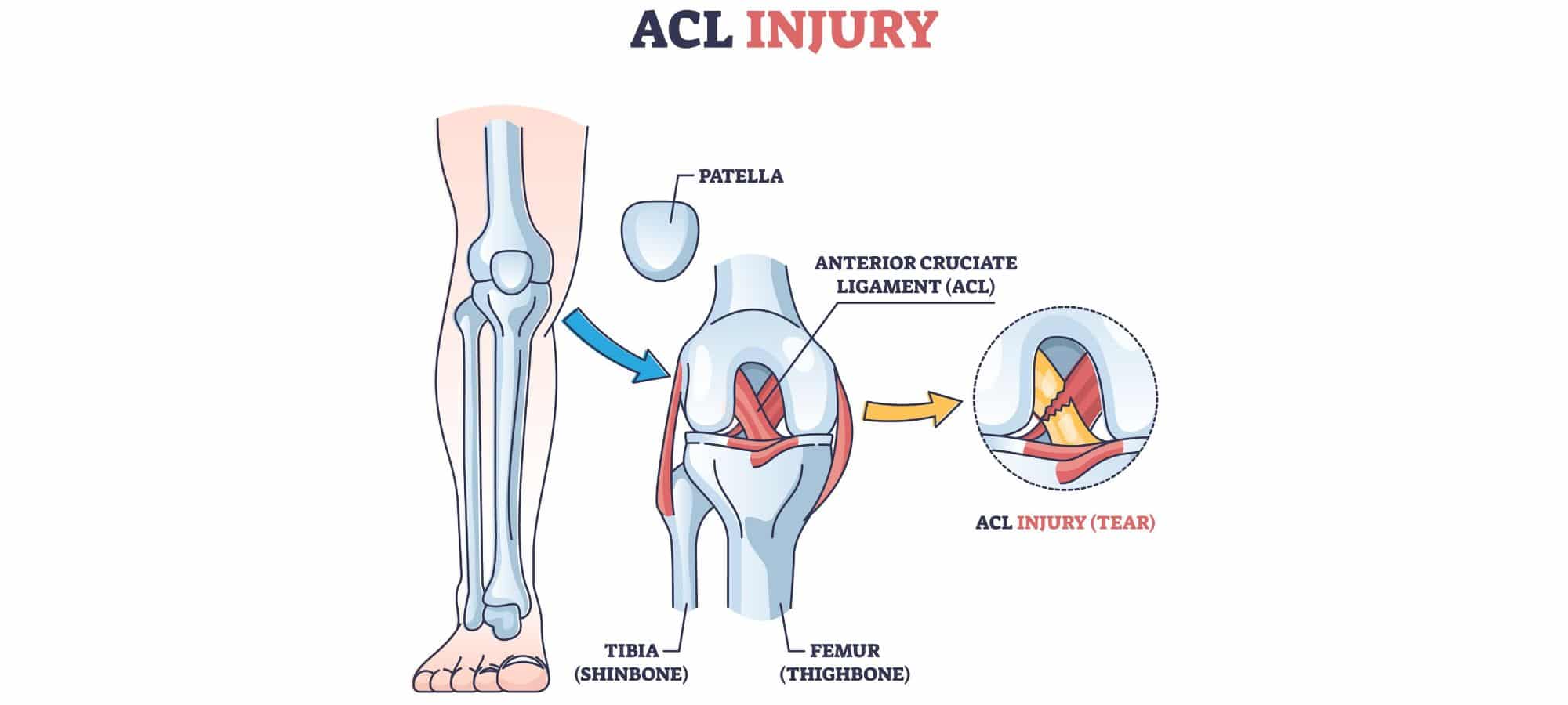 acl tear