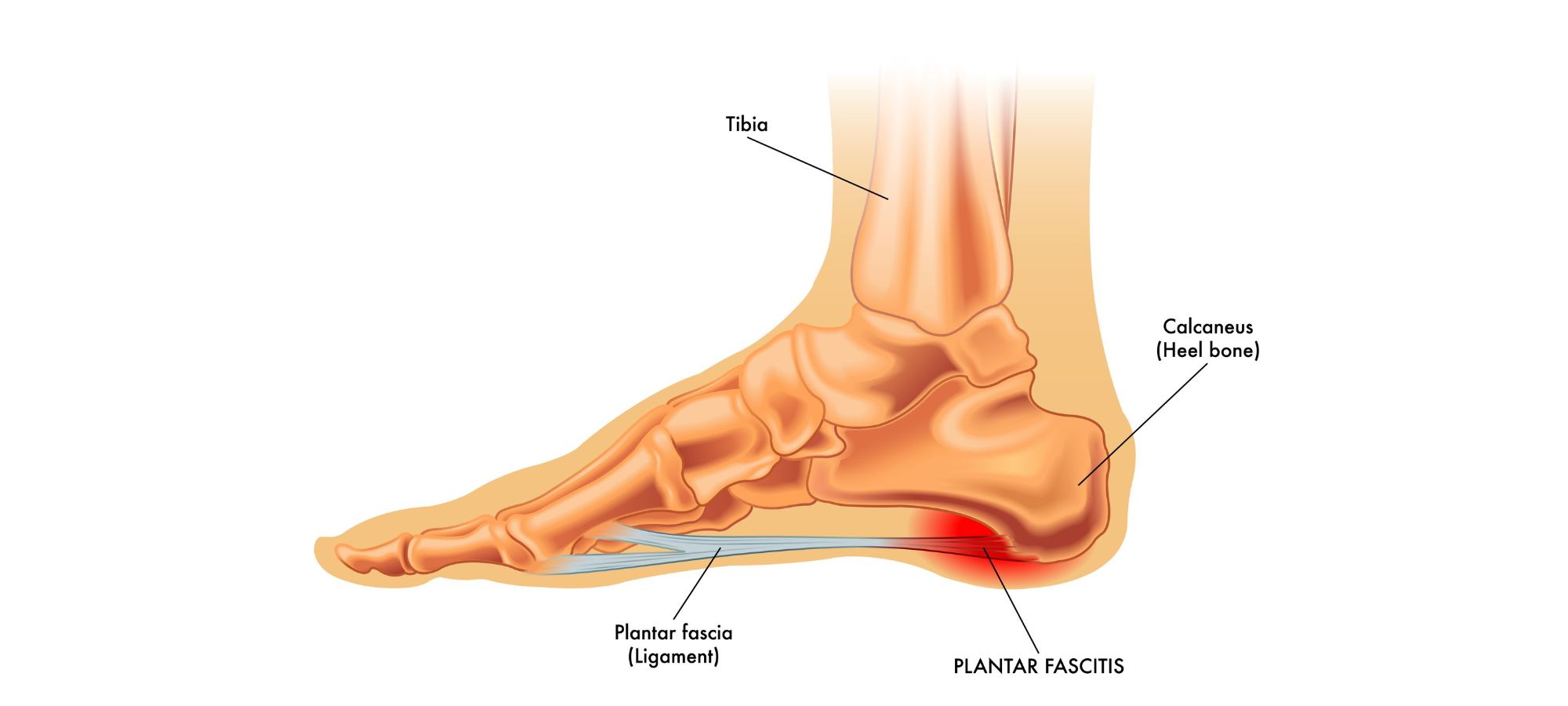 plantar fasciitis