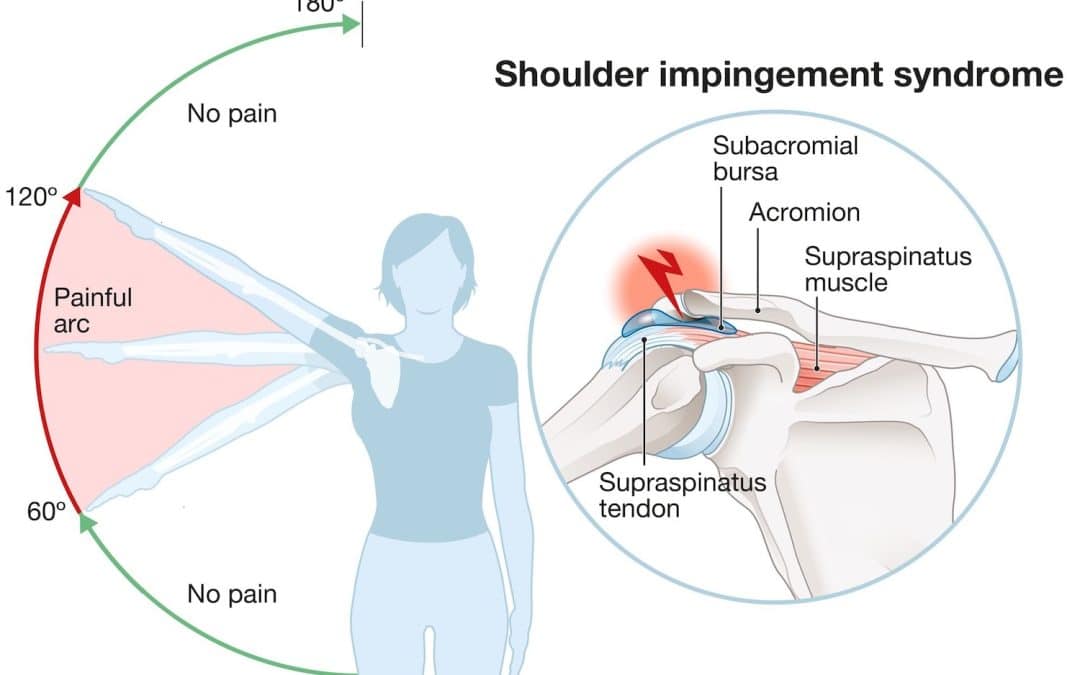 Shoulder Impingement Syndrome – What It Is And How To Fix It