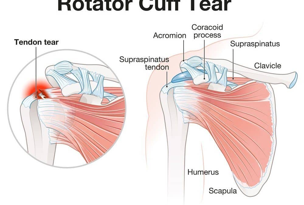 Torn Rotator Cuff – What Does It Mean?