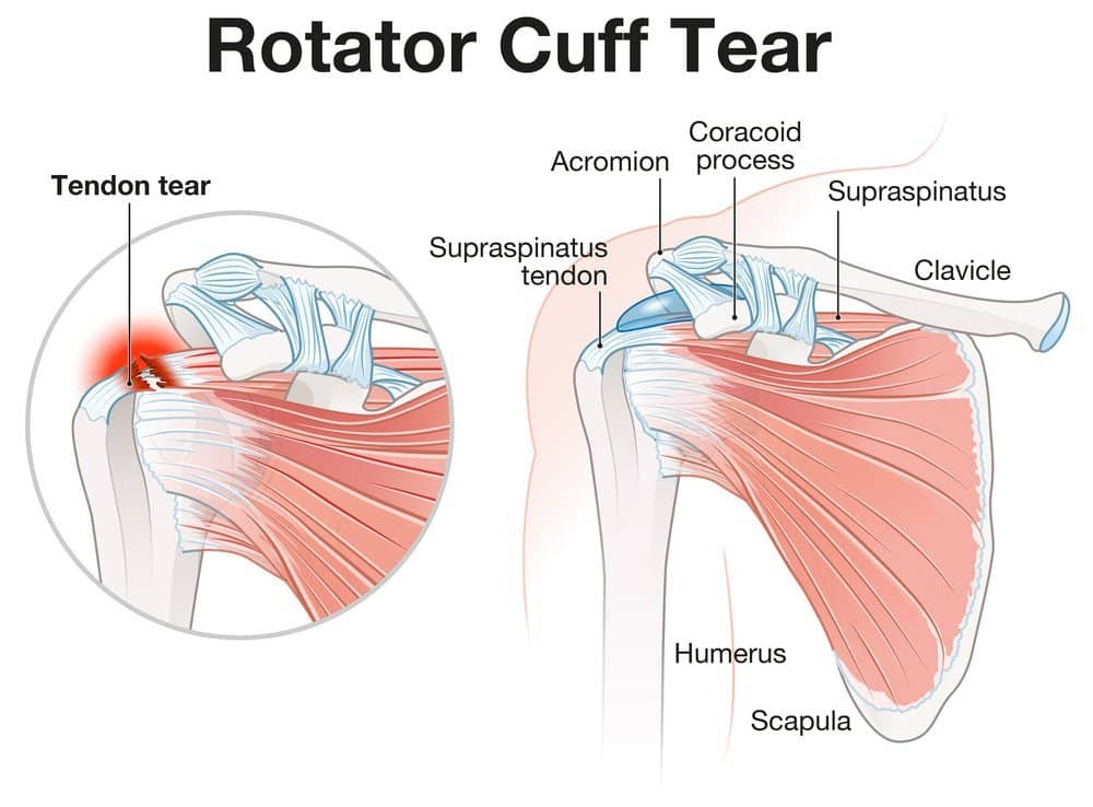 torn rotator cuff - victoria bc